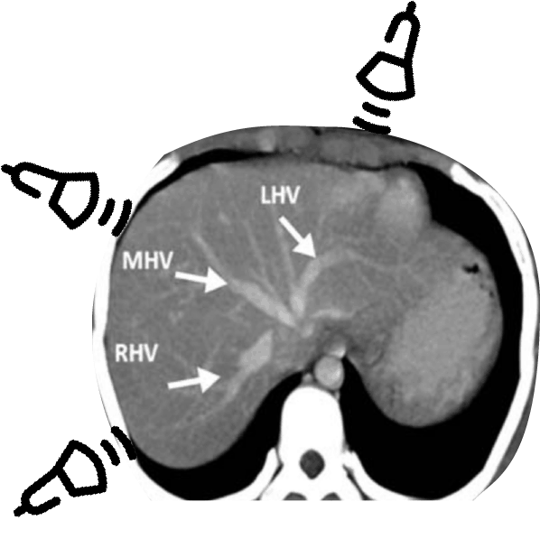 Hepatic Veins-CT