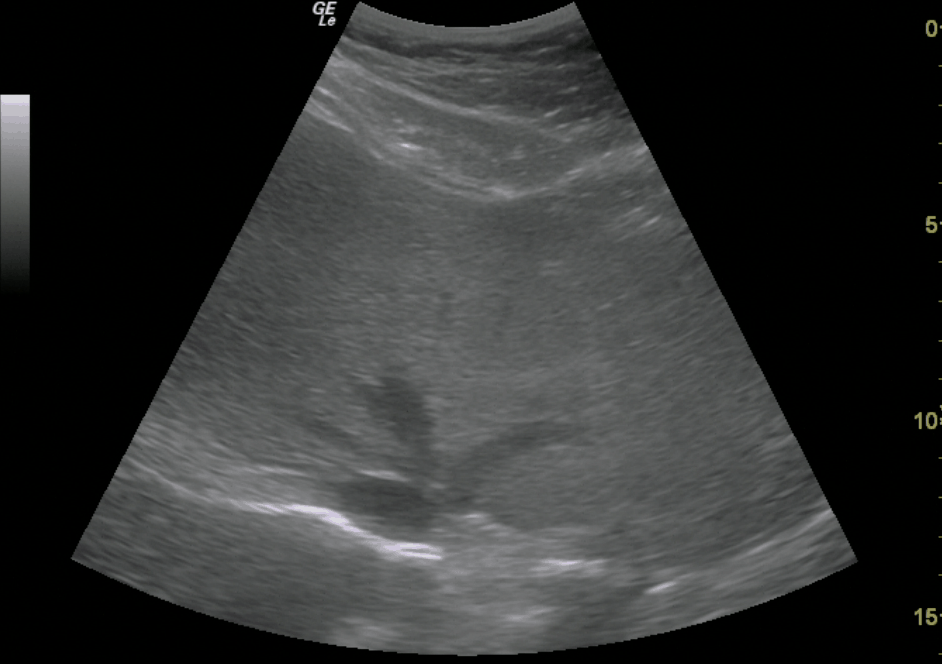 Hepatic Veins