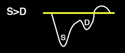 Normal Hepatic Vein Doppler