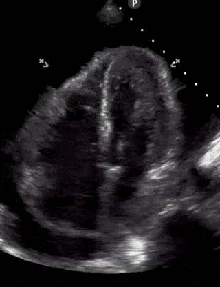 Pericardial Effusion with Tamponade and RA systolic collapse