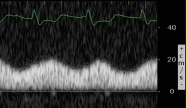 Portal Vein Doppler Grade 1