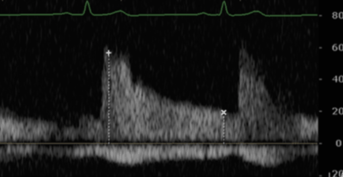 Renal Doppler Grade 0