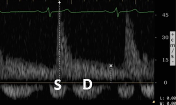 Renal Doppler Grade 1