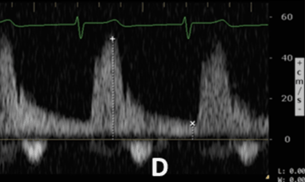 Renal Doppler Grade 2