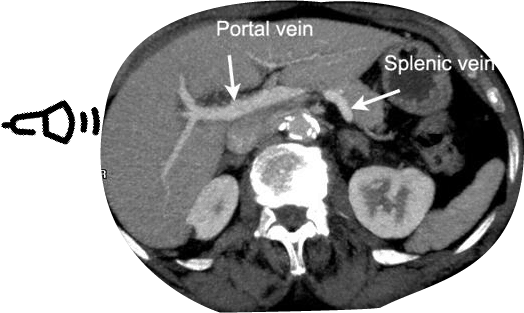 Right Portal Vein