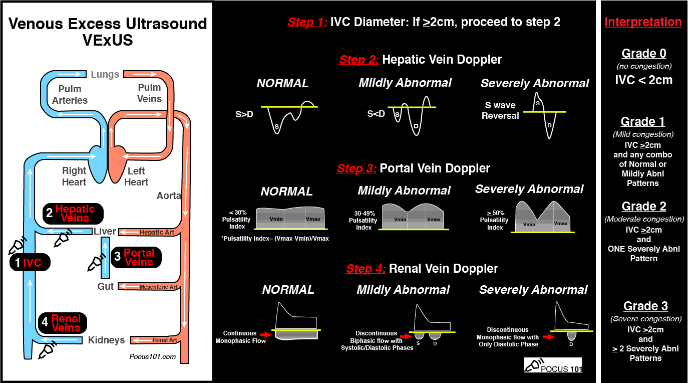 VExUS Ultrasound Score Pocket Guide PDF