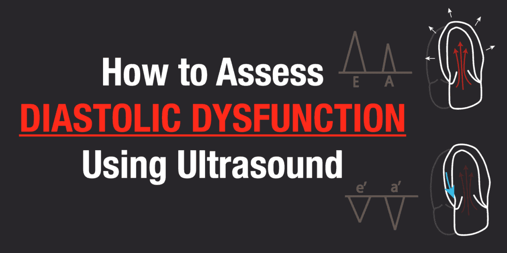 How to Assess and Grade Diastolic Dysfunction Using Ultrasound - POCUS 101