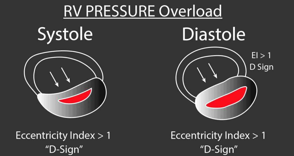 Right Ventricular Pressure Overload with D Sign