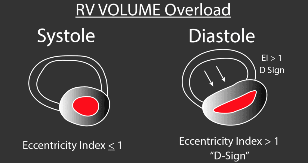 Right Ventricular Volume Overload with D Sign