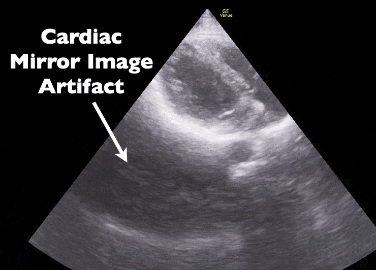 Ultrasound Artifact - Mirror Image Cardiac