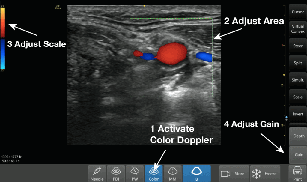 Color Doppler Step by Step Guide