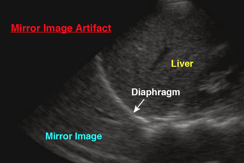 Mirror Image Artifact - Liver, Diaphragm, Lung