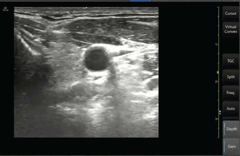 Overgained Ultrasound Image