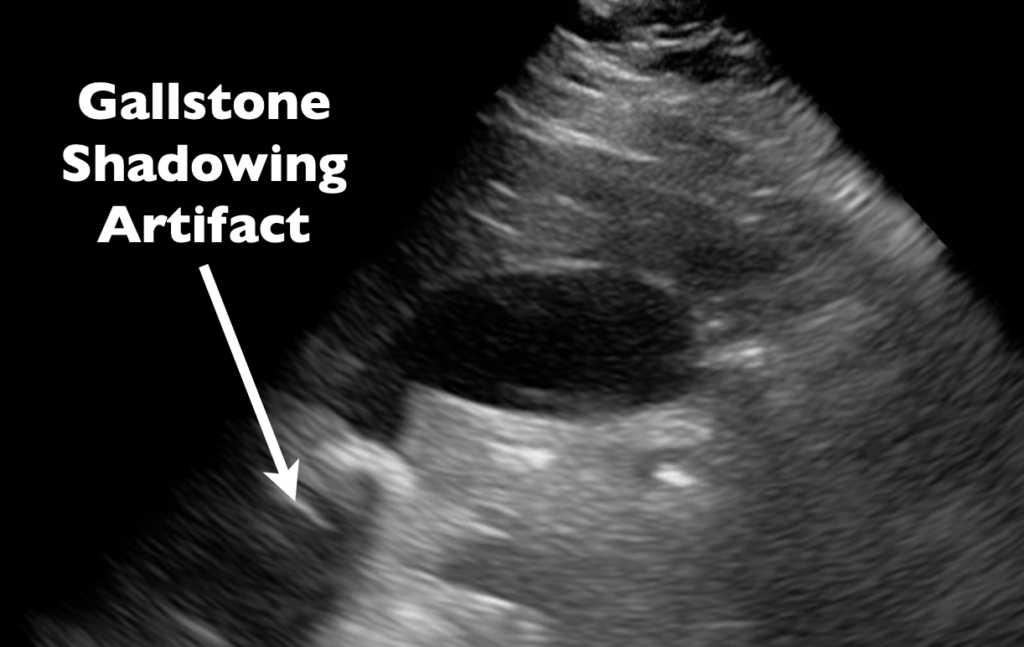 Ultrasound Artifact - Gallstone Shadowing