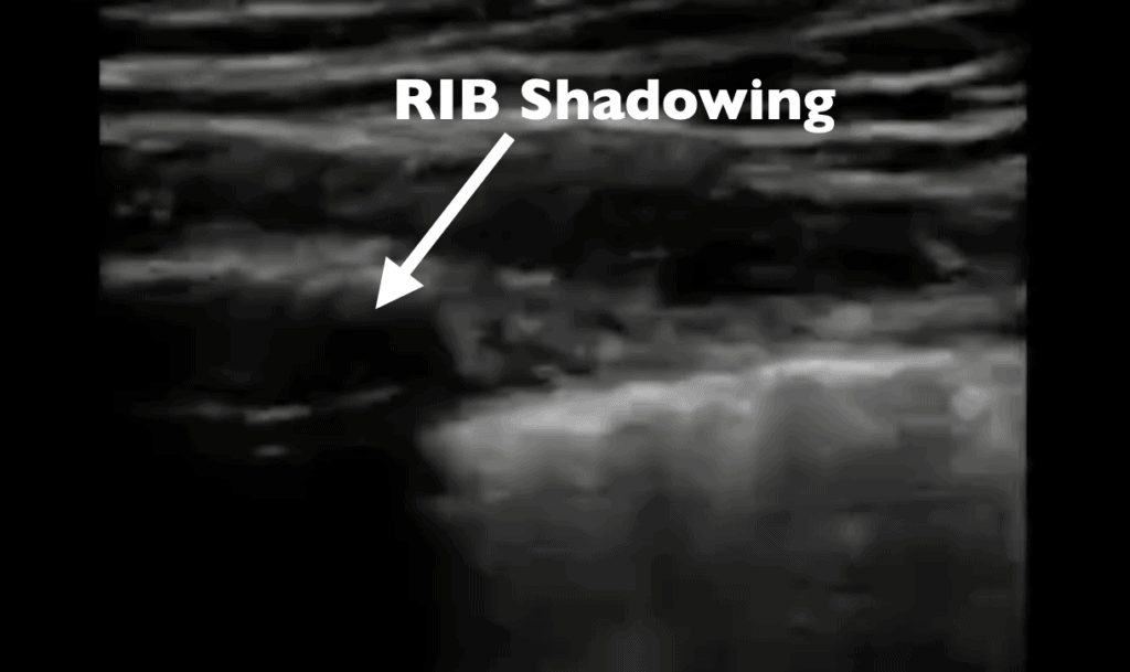 Ultrasound Artifact - Rib Shadow