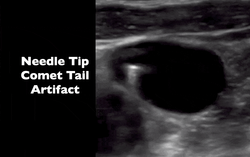 Ultrasound Comet Tail Artifact Needle