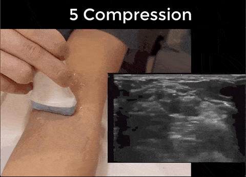 Ultrasound Movement - Compression