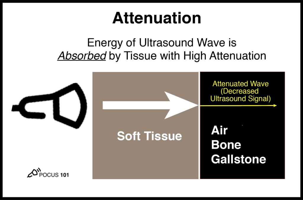 Ultrasound Physics Attenuation Artifact Absorption Bone Air Gallstone