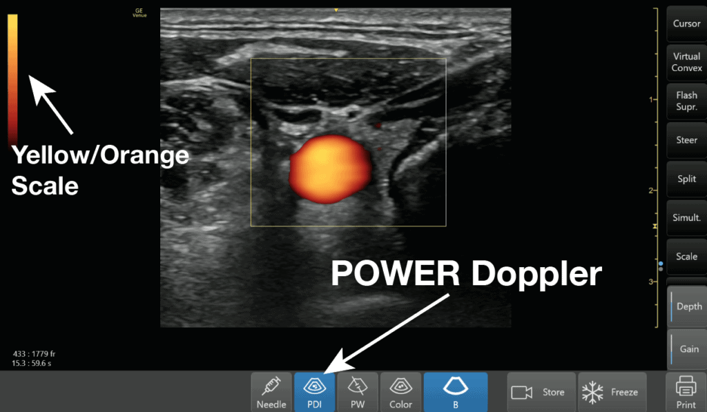 Ultrasound Power Doppler Setting