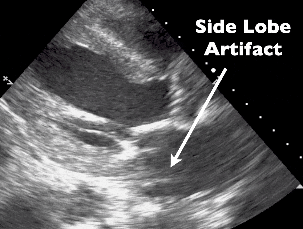 Ultrasound Side Lobe Artifact - Mitral Valve