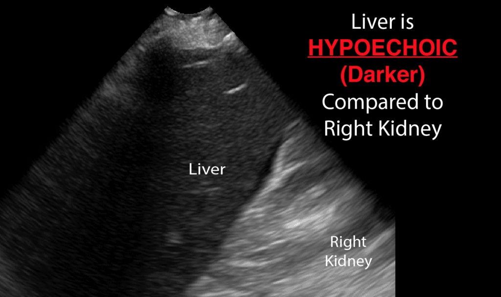 Ultrasound Terminology - Hypoechoic Liver
