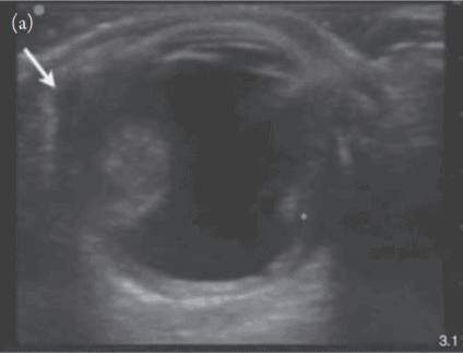 Ocular Ultrasound Globe Rupture with Scleral Buckling