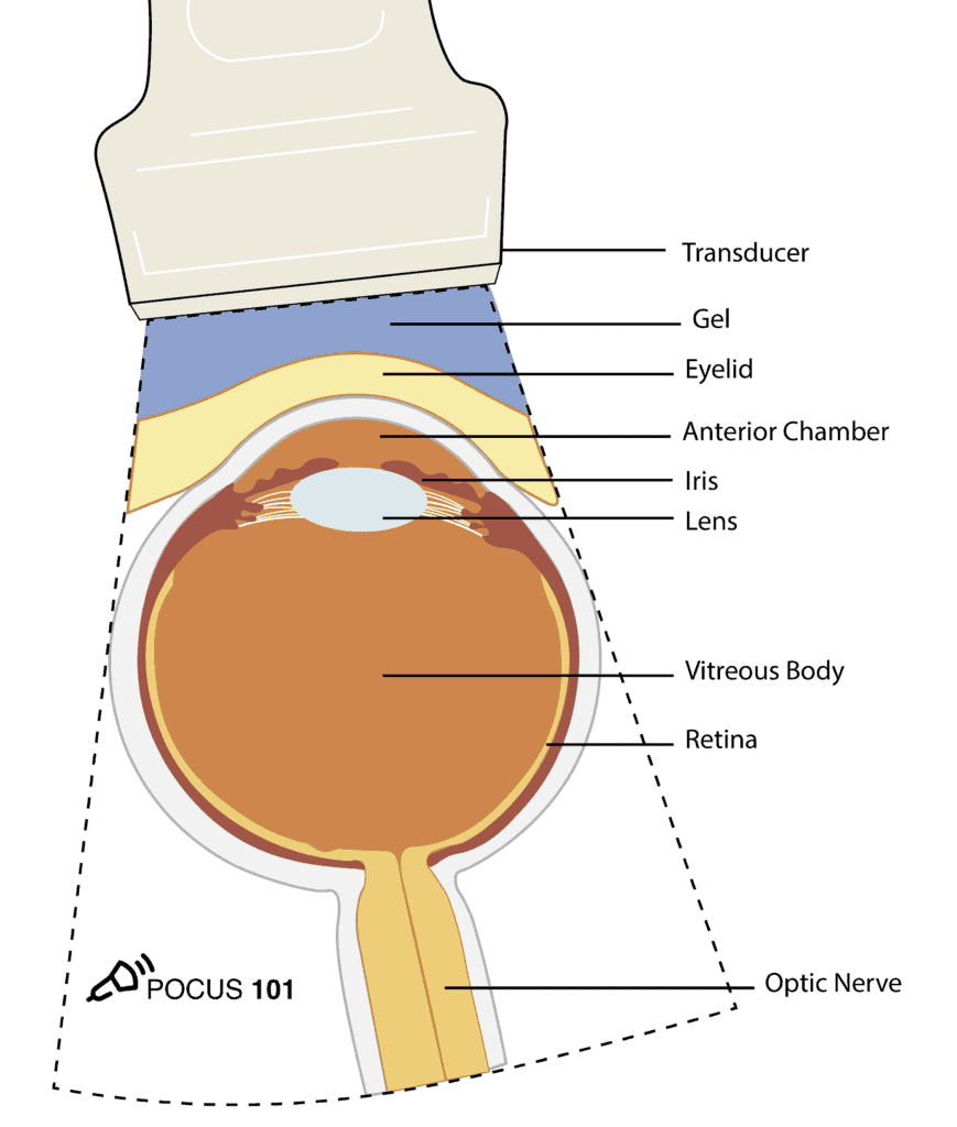 Ocular Ultrasound Illustration with Labels Normal Anatomy
