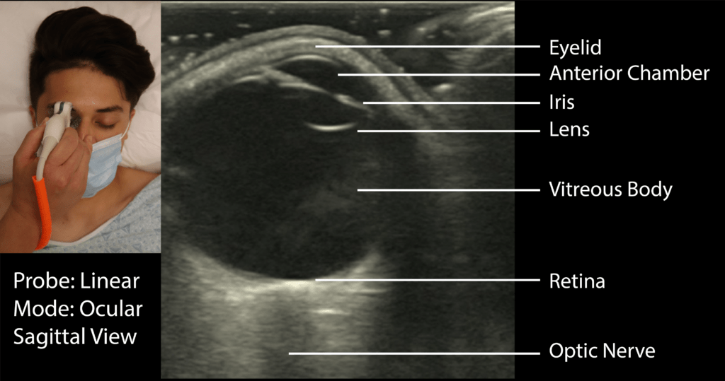 Ocular Ultrasound Sagittal View with Labels