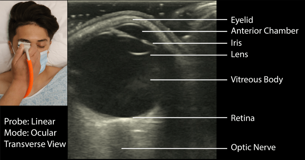 Ocular Ultrasound Transverse View with Labels