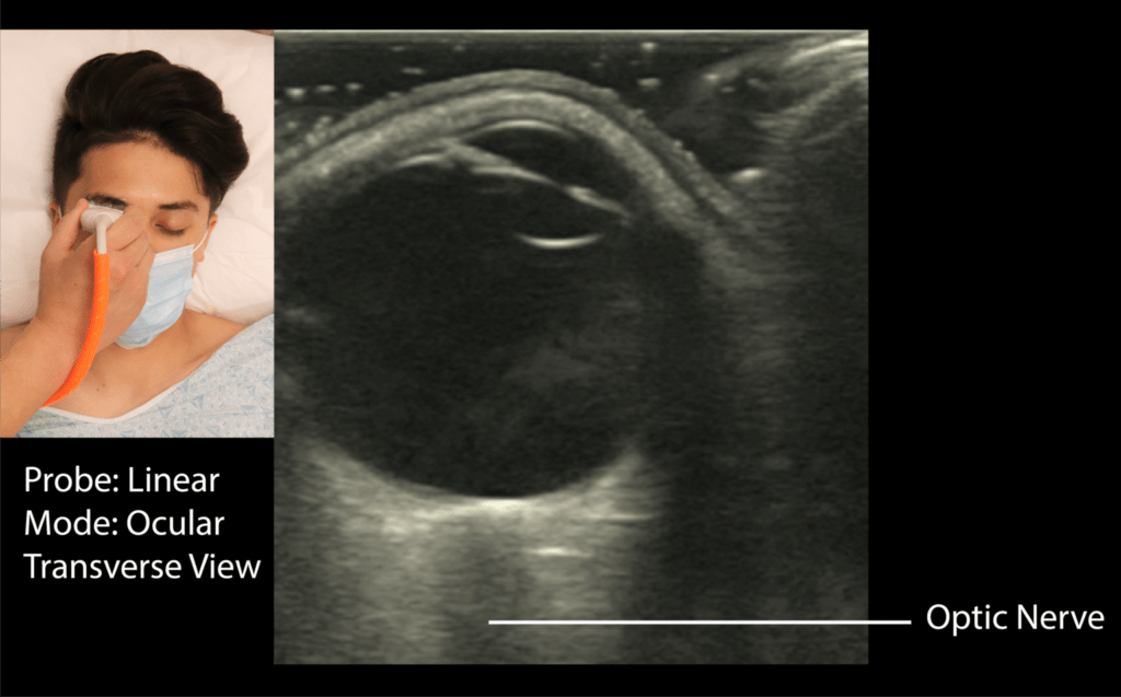 Optic Nerve Sheath Diameter for ONSD Ultrasound