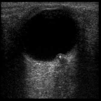 Pseudotumor Cerebri Ocular Ultrasound Optic Disc Bulging elevation Papilledema