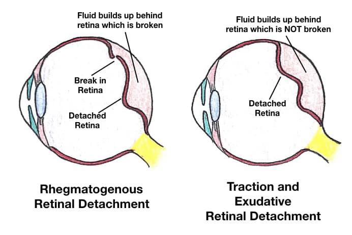 Retinal Detachment Types Rhegmatogenous, Traction, Exudative