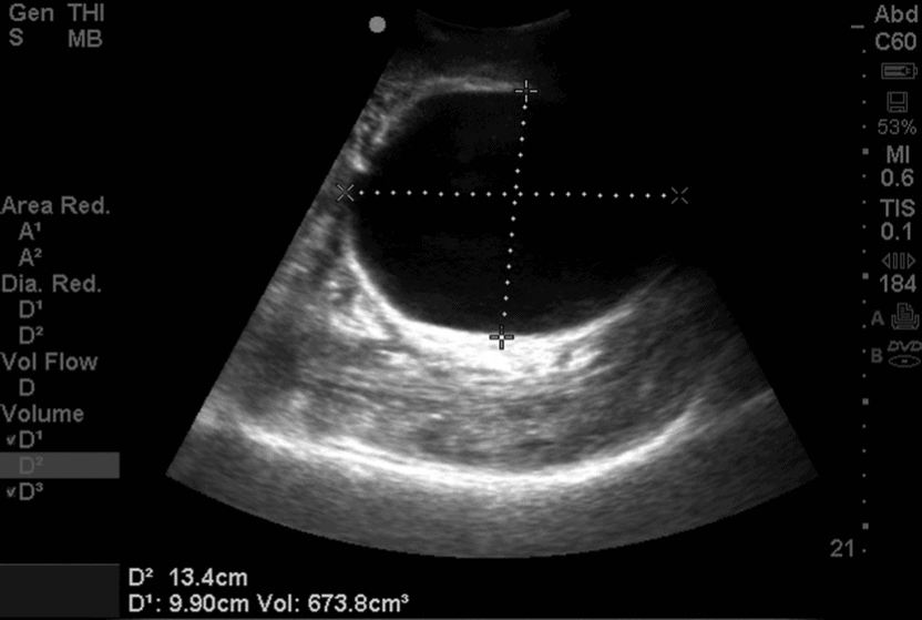 Abnormal Post Void Residual