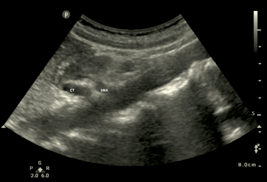 Aorta Aortic Ultrasound Long Axis Celiac Trunk and Superior Mesenteric Artery SMA