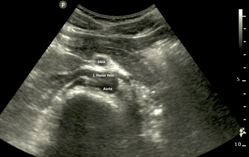 Aorta Aortic Ultrasound SMA Left Renal Artery