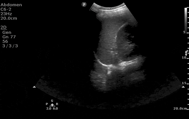 Aorta View from Left Lateral Approach