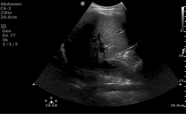 Aorta View from Right Lateral Approach