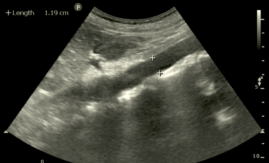 Aorta ultrasound Long Axis Measurement