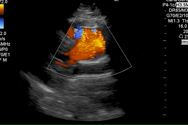 Aortic Dissection Aortic Regurgitation Ultrasound