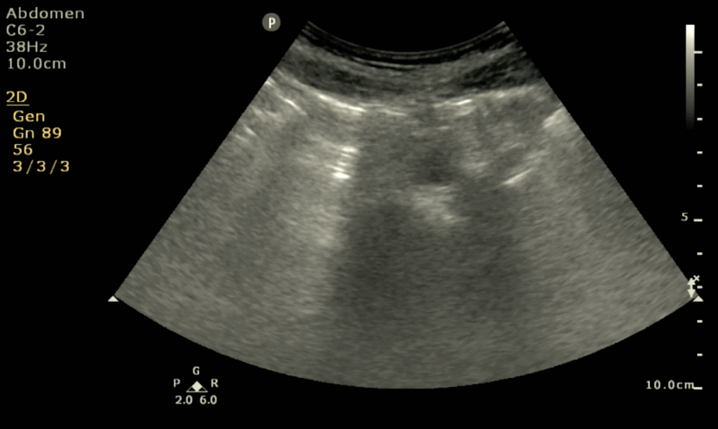 Bowel Gas Aorta Ultrasound