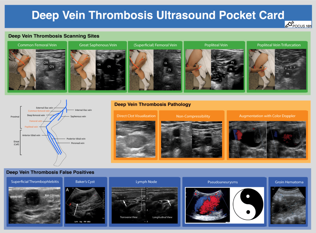 DVT Ultrasound Deep Vein Thrombosis Pocket Card POCUS 101