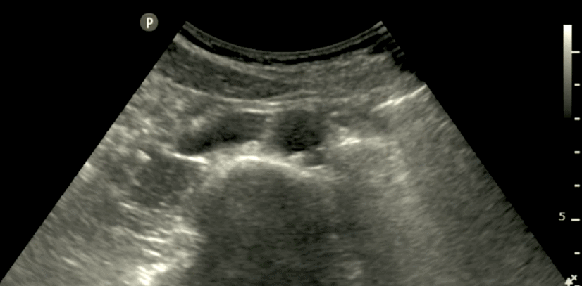 Distal Abdominal Aorta Ultrasound