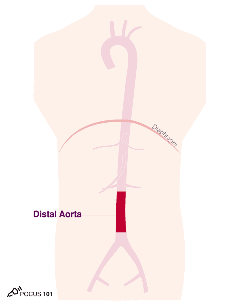 Distal Aorta Illustration