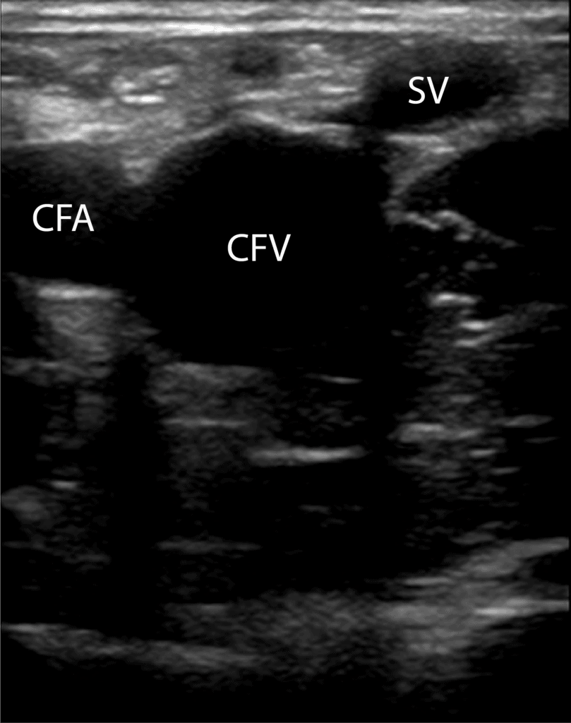 GSV Great Saphenous Vein DVT Ultrasound Normal