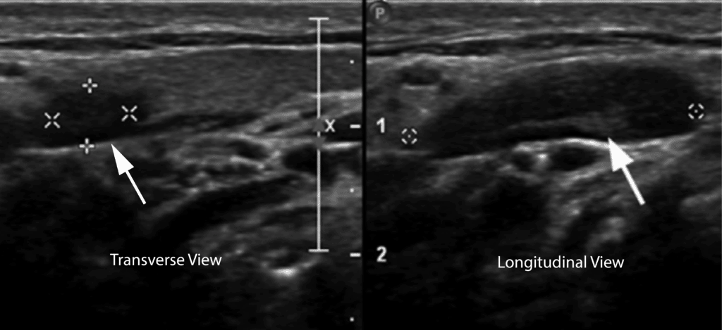 Lymph Node False Positive DVT Ultrasound