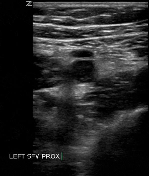 Non-compressible Superficial Femoral Vein SFV DVT Ultrasound