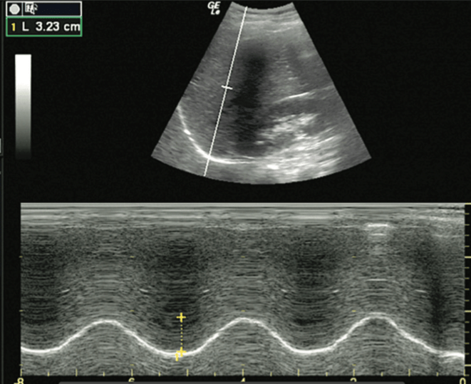 Normal diaphragmatic excursion using M-mode.