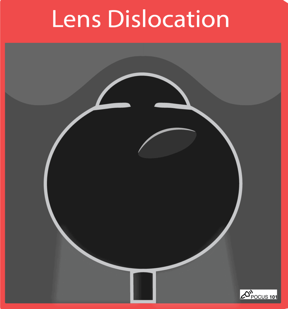 Ocular Ultrasound - Lens Dislocation Illustration POCUS 101