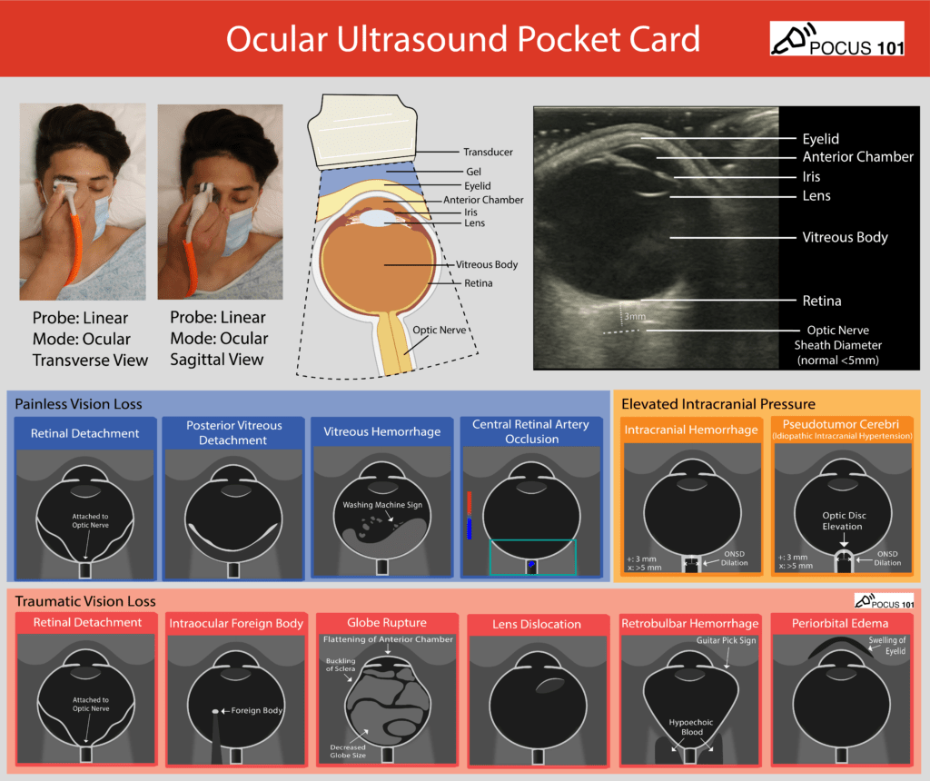 Ocular Ultrasound Pocket Card POCUS 101