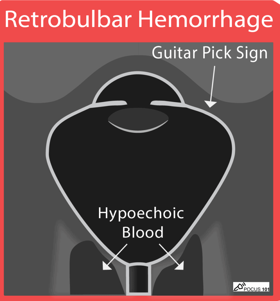 Ocular Ultrasound - Retrobulbar Hemorrhage Illustration - Guitar Pick Sign POCUS 101